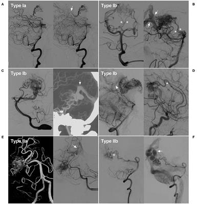 Imaging Characteristics and Endovascular Treatment of Brain Arteriovenous Malformations Mainly Fed by the Posterior Cerebral Artery